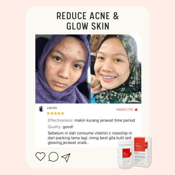 Acne Review 2