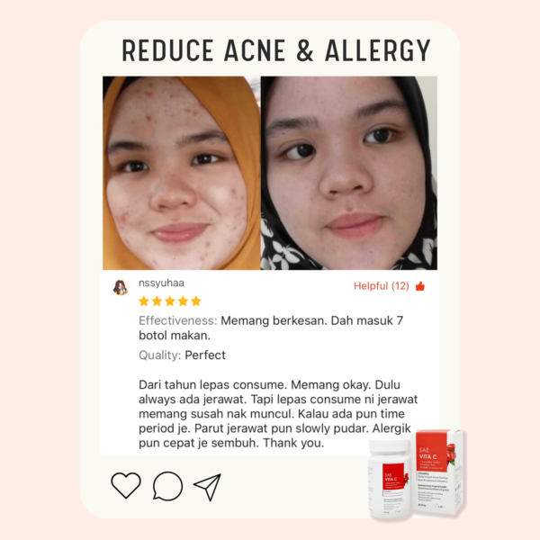 Acne Review 3