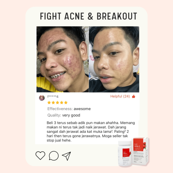 Acne Review 4