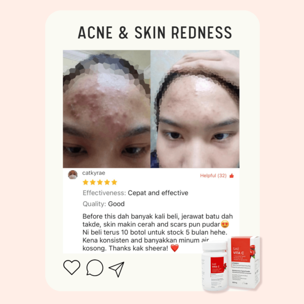 Acne Review 5