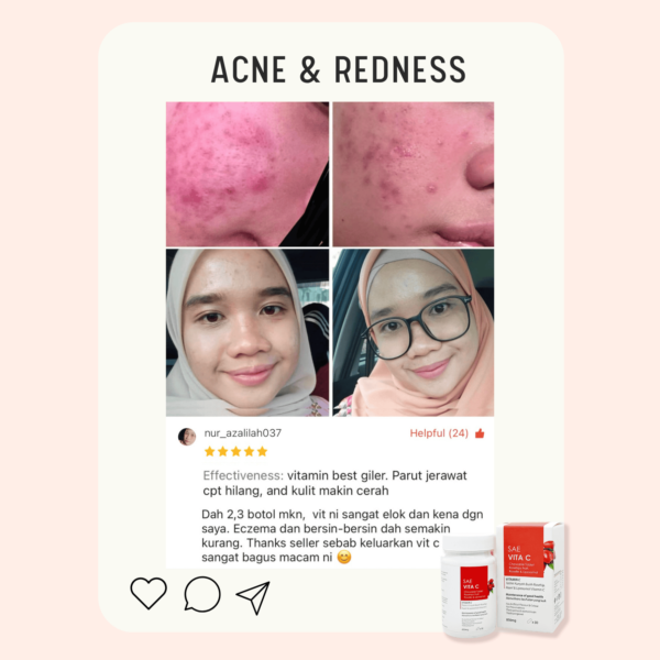 Acne Review 6