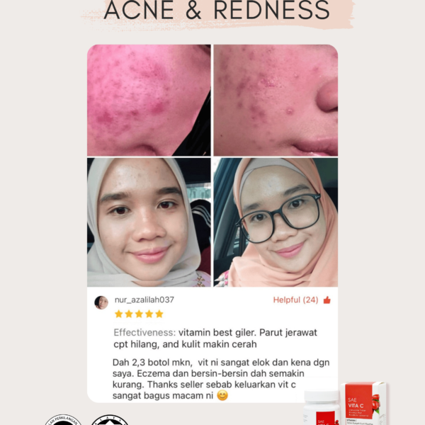 ACNE 3